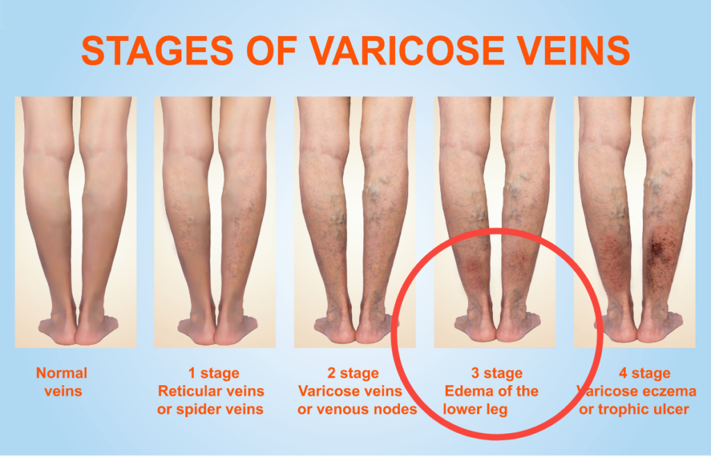 Dangers of Varicose Veins