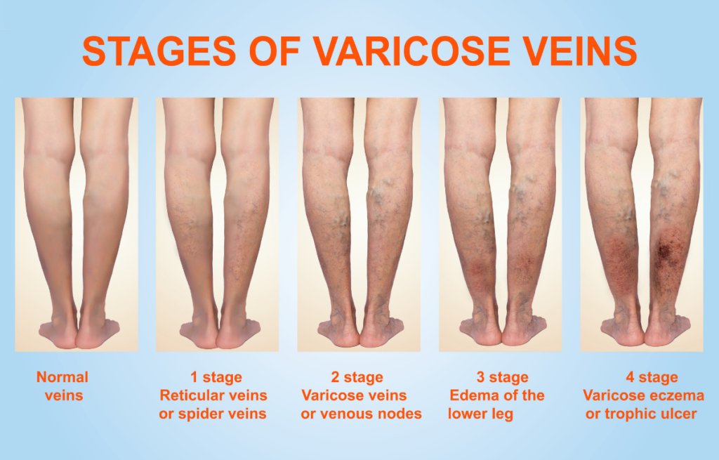 Top 3 Signs of Vein Disease 